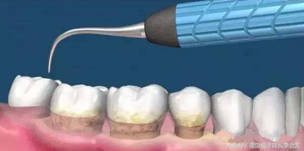 为什么洗牙过后牙缝变大,洗牙后牙缝变大了怎么矫正