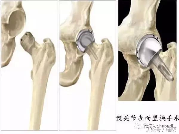 髋关节置换术护理疑难病例讨论,髋关节置换病人的护理与饮食