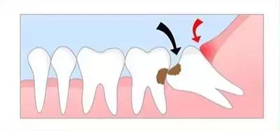 智齿发炎缓解最快最有效的方法,长智齿但是不能拔牙怎么办