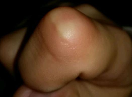 我的腱鞘炎治疗过程记录,医生解决腱鞘炎最简单自愈方法