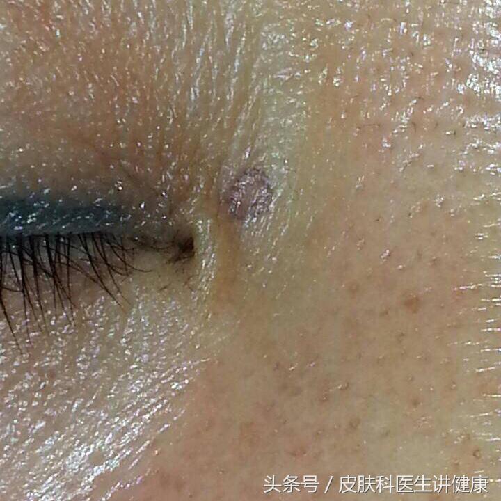 色素痣会出现大面积皮肤发黑吗,如何区分黑斑与色素痣