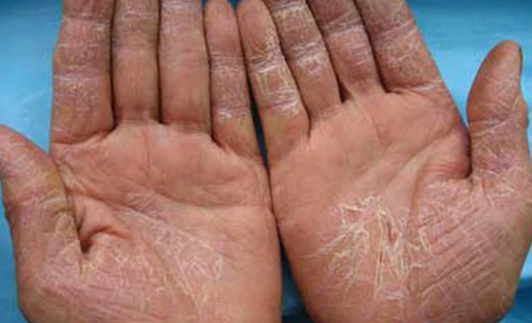 容易长湿疹教你3个方法赶走湿疹,患了湿疹怎么办教你一招简单高效