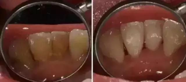 满嘴牙齿松动发疼是怎么回事,早上起床牙齿松动怎么回事