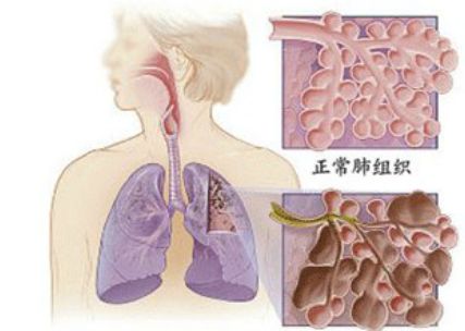 老慢支肺气肿注意事项,老慢支肺气肿需要做哪些治疗