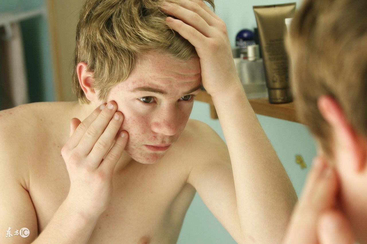 油性皮肤怎样护理才不长痘,油性皮肤额头长痘怎么办