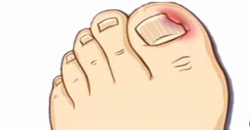 脚趾甲根部长进肉里怎么办,脚趾甲长进肉里怎么根治
