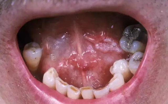 还需高度警惕口腔癌,口腔癌的真正罪魁祸首