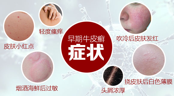 从心关注,银屑病缠身的治疗方法