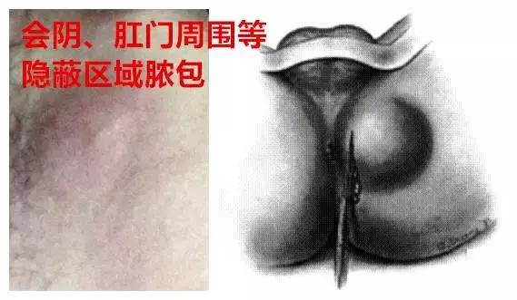 感染导致肾病加重,感染加重的肾病还能恢复吗