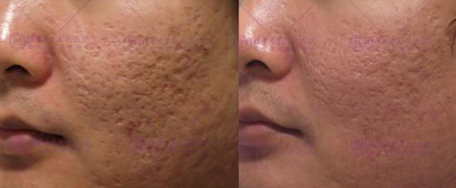 专家推荐祛痘方法,医生推荐祛痘痕痘印最有效的办法