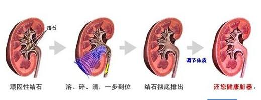 大的肾结石最好的治疗方法,肾结石体外震波碎石适合多大结石