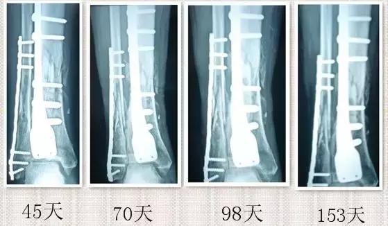 骨折多月了始终不愈合？！骨不连的危害真的有这么大？！