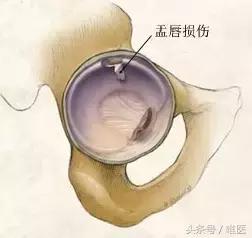 容易误诊成股骨头坏死的疾病,磁共振股骨头坏死有没有可能误诊