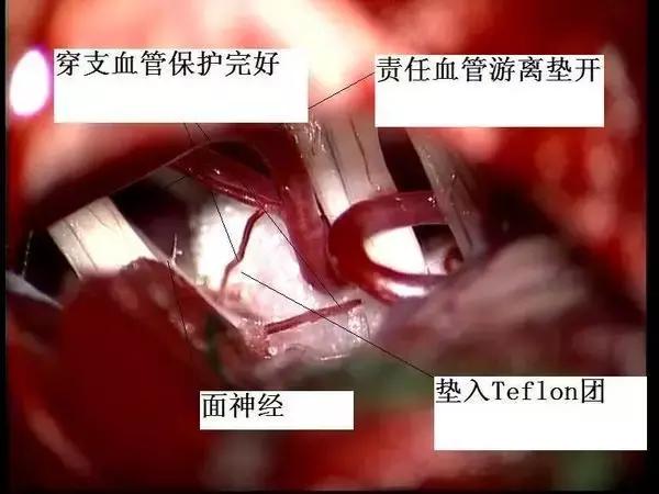 健康——武汉市中心医院王潞教你解决“天下第一痛”