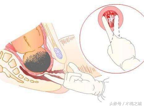 生孩子是十指开全了才用力吗,生小孩的开十指是掰开的吗