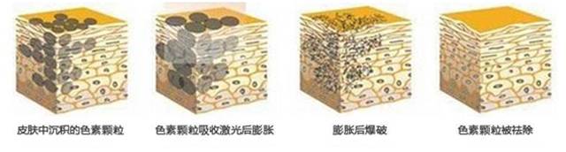 脸上突然出现很多褐斑,脸上褐斑的最好治疗方案