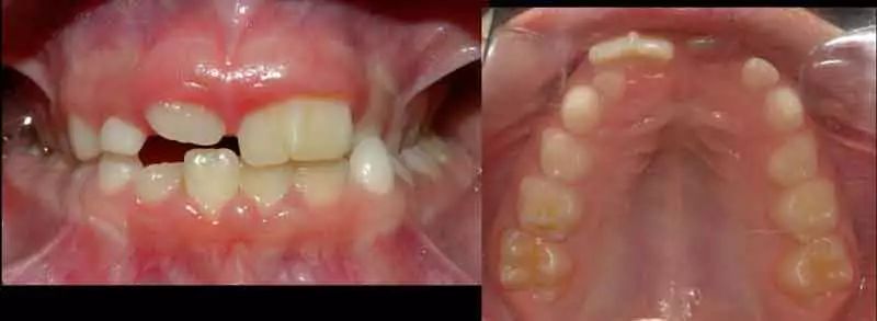 双牙重叠,连着两颗牙齿松动怎么办