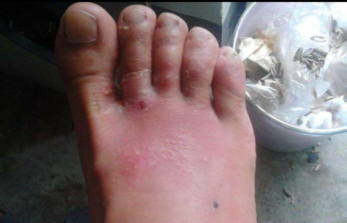 脚气、长水泡、瘙痒等！一招轻松搞定！