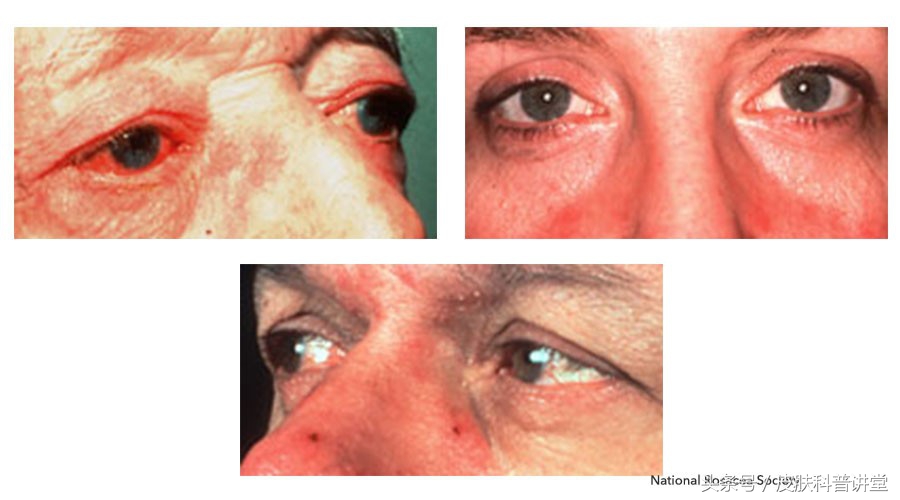 酒渣鼻玫瑰痤疮是怎么引起的,玫瑰痤疮会变成酒渣鼻吗