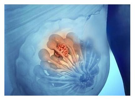 20岁女孩乳腺纤维瘤正常吗,27岁女孩得乳腺纤维瘤