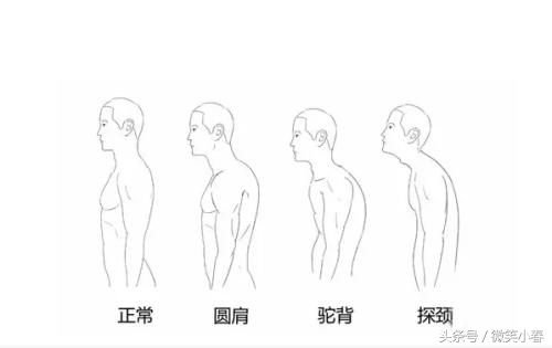 驼背耸肩缩脖子含胸如何纠正,耸肩驼背最佳纠正方法