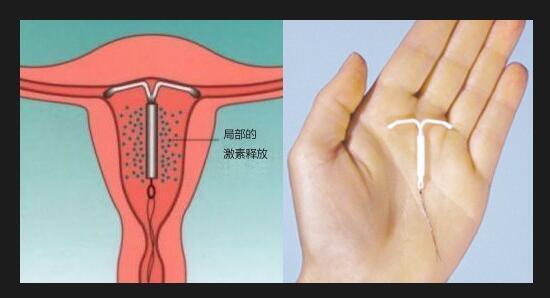 妇科上环7年了取了环会怀孕吗,妇科主任取环