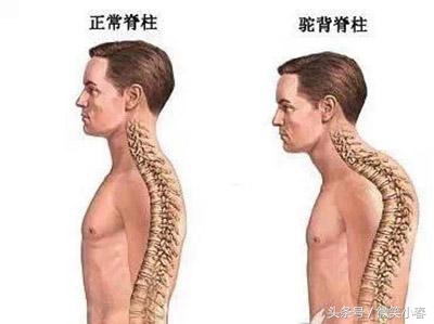 驼背耸肩缩脖子含胸如何纠正,耸肩驼背最佳纠正方法