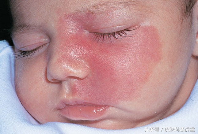 鲜红斑痣和新生儿红胎记区别,激光染料治疗网状鲜红斑痣的效果
