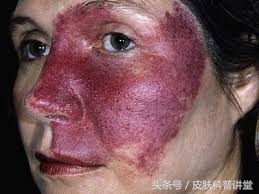 鲜红斑痣和新生儿红胎记区别,激光染料治疗网状鲜红斑痣的效果