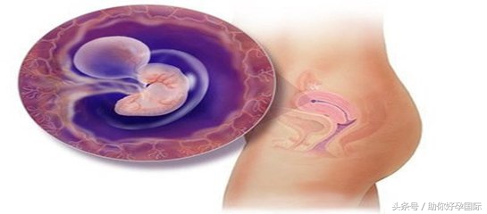 瘢痕子宫怀孕后要注意些什么,瘢痕子宫再怀孕需要注意什么