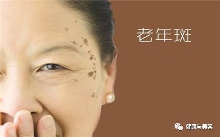 斑点消除办法,斑点的形成和去除方法