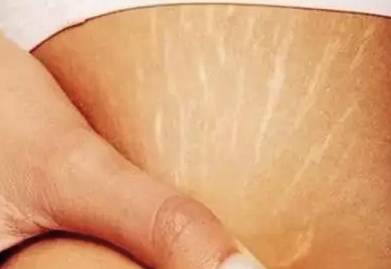 什么淡化妊娠纹肥胖纹简单又有效,妊娠纹与肥胖纹用什么方法去除