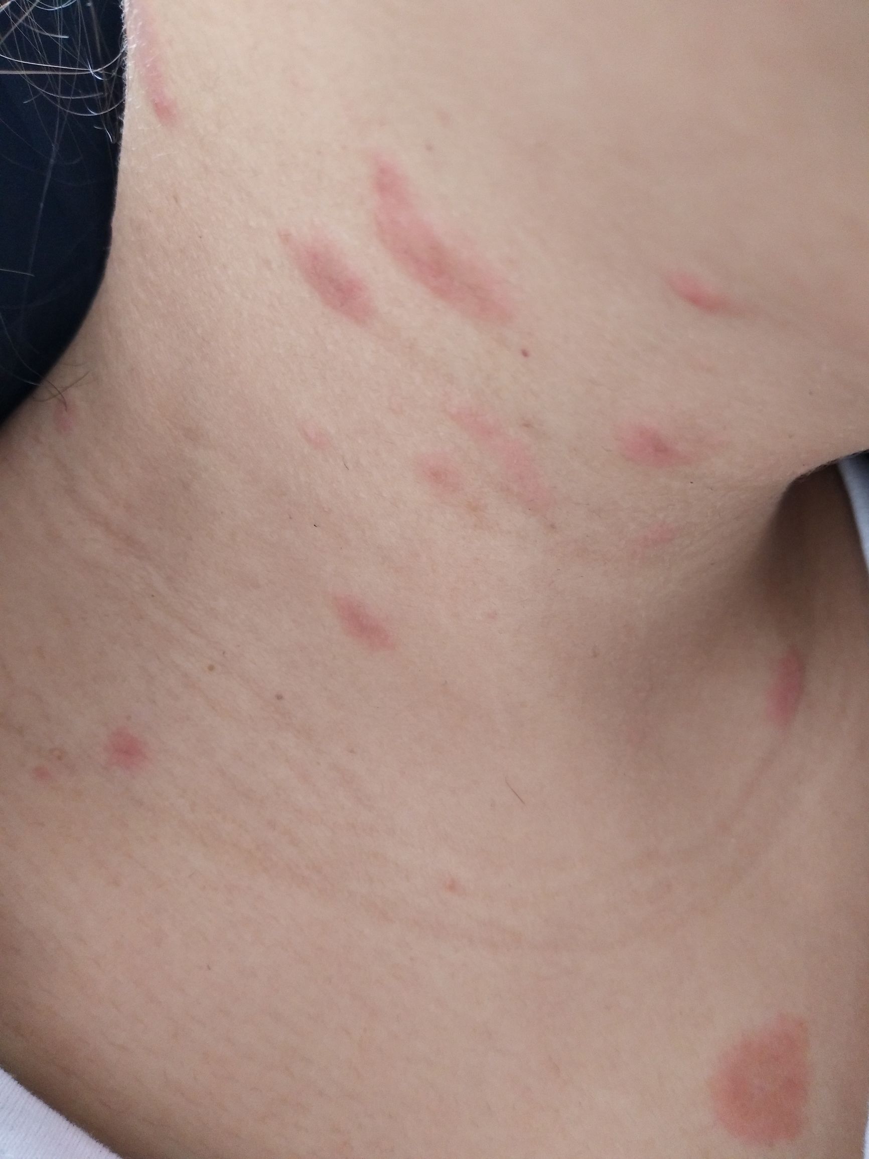 玫瑰糠疹有什么需要注意的,玫瑰糠疹自愈后还需要忌口吗