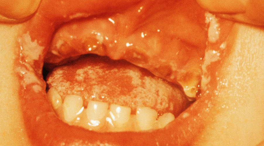 一个不能忽略的感染,皮肤真菌感染的药物治疗