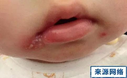 孩子春天烂嘴角怎么办,夏季宝宝烂嘴角最快治疗方法