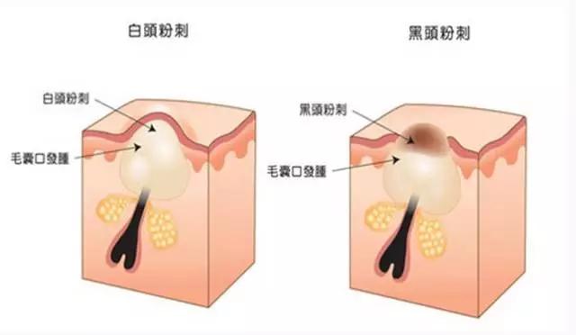 脸上能挤出白色小东西是什么,脸上鼻头挤出白色颗粒