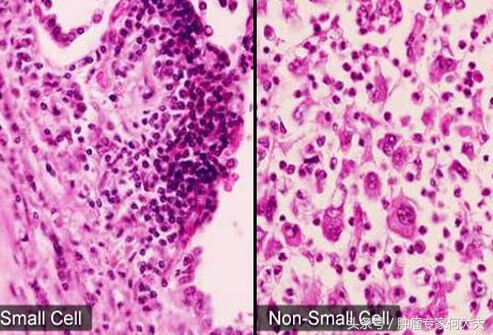 初期肺癌喝中药能消除吗,早期肺癌可以喝中药治愈吗
