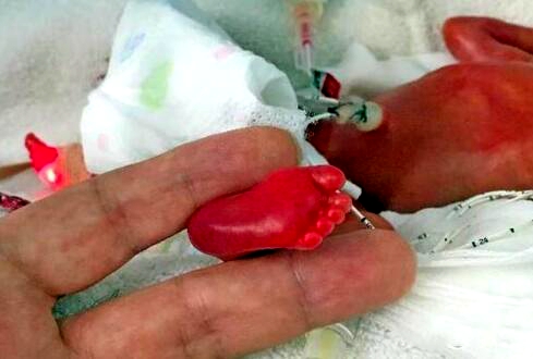 年轻妈妈产微型婴儿，花几十万也保不住，医生大怒：你们干的好事