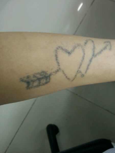 激光洗纹身需要修复吗,纹身后悔了怎么办啊