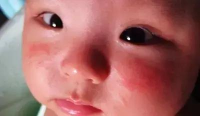 如何区分痱子和湿疹婴儿,湿疹和痱子怎么判断