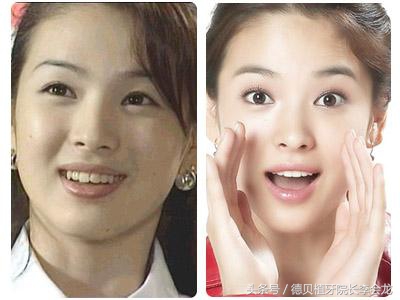 牙齿不齐矫正牙齿的最佳年龄,牙齿排列不齐有必要矫正吗