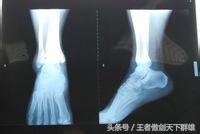 脚崴到了肿了应该怎么办,脚崴到了肿了怎么办多久可以好