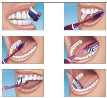 牙龈出血是牙周炎的早期信号,刷牙牙龈出血是什么原因引起的