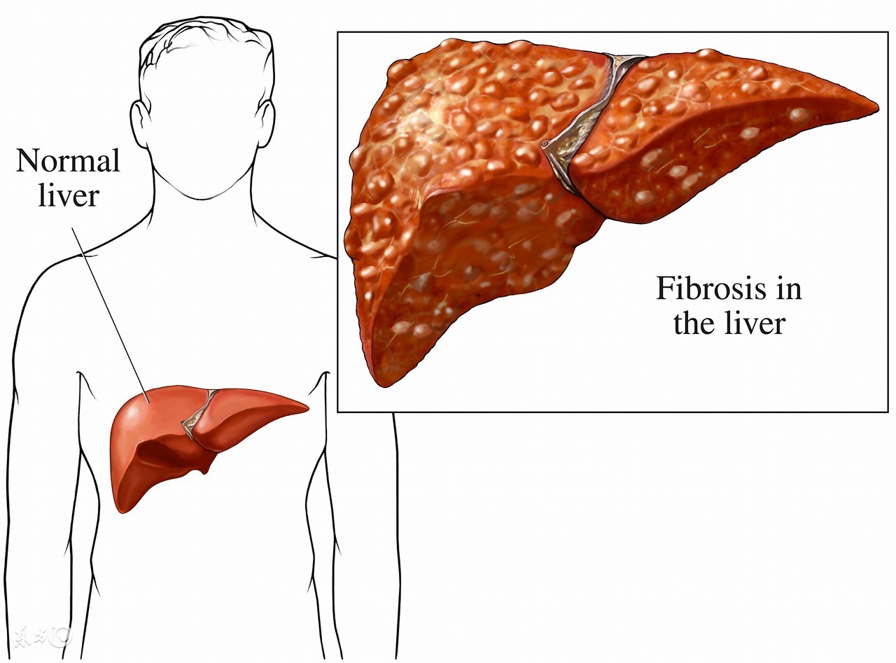 酒精中毒怎么治才能除根,酒精中毒怎么办如何处理
