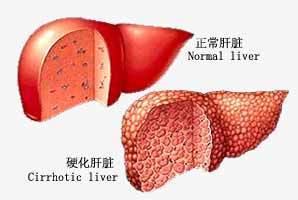 肝硬化并发症治愈后还会复发吗,肝硬化并发症治疗