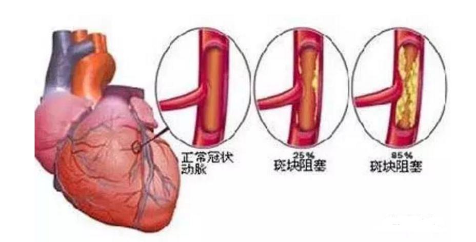 中医治疗心脑血管站桩,练太极站桩对心脑血管有帮助吗