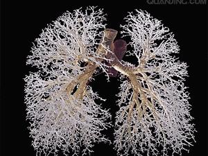 支气管扩张是大病吗,支气管扩张