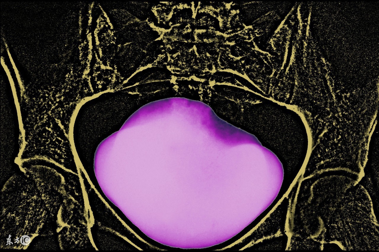 膀胱腹膜外破裂多久自愈,腹膜内型膀胱破裂名词解释