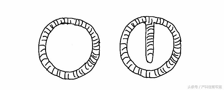 放置宫内节育器请什么假,宫内节育器放置全过程