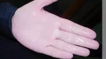 手心出汗怎么办不吃药,手心出汗好尴尬